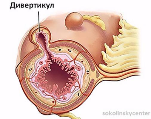 Дивертикулез кишечника. Причина. В чем скрытая опасность?